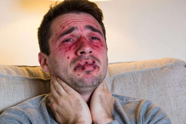 红酒过敏怎么办？这些缓解方法你不能错过